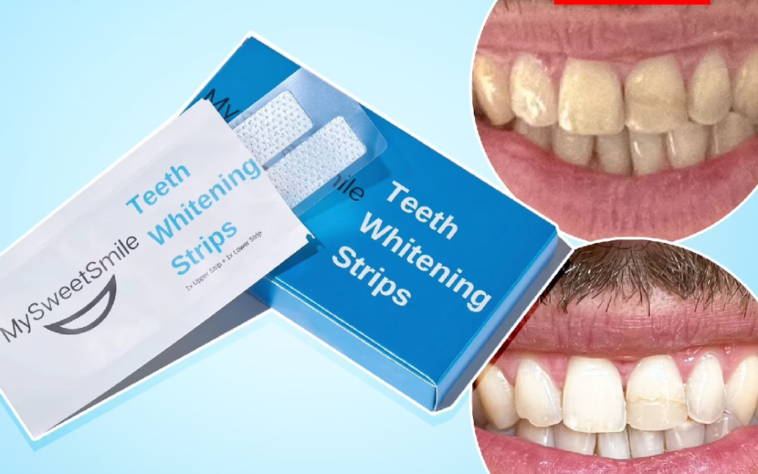 Teeth Whitening Strips (Ultra Strong Whitening)